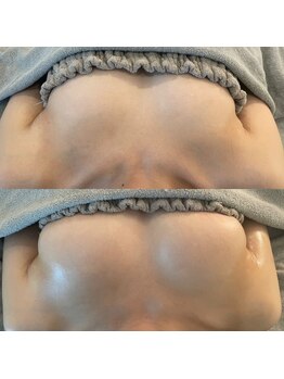 美人バスト 渋谷店/【バストアップ】症例☆