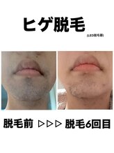 サロンエヌ 久留米店(Salon N)/男性のヒゲ脱毛★