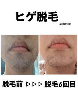 サロンエヌ 久留米店(Salon N)/男性のヒゲ脱毛★