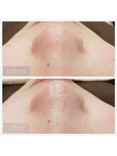 ムー(MUU)/《毛穴洗浄before＆after》