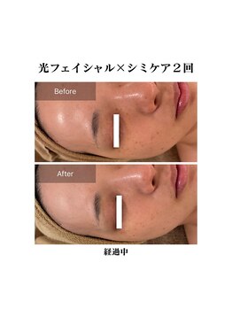 エムドット プラス(M DOT +)/シミケア×最新光フェイシャル