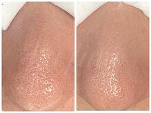 カピリナ(ka pilina)/透明感がぐっと上がる毛穴ケア★