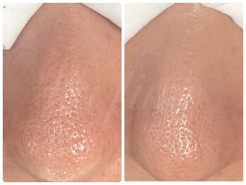 カピリナ(ka pilina)/透明感がぐっと上がる毛穴ケア★