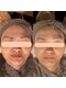 リスタ(RSTA)の写真/ほうれい線・たるみ改善に集中！丁寧なカウンセリングで、自信あふれるフェイスラインへ導きます！