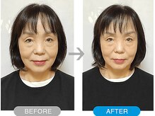 ワト(WATO)/■小顔施術（before→after)