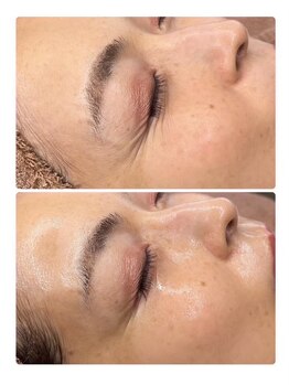 ホワイトアクア 姫路店(WHITE AQUA)/ララピール/姫路/毛穴