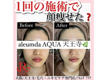 アルムダアクア 天王寺店(Aleumda AQUA)/ハーブピーリング/大阪/天王寺
