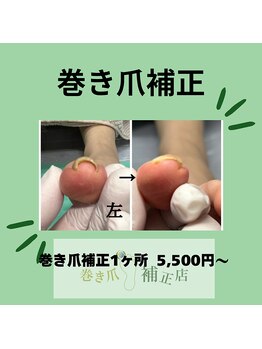 巻き爪補正店 徳重店/巻き爪補正