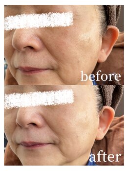 コスメティック雅/【毛穴開き改善】