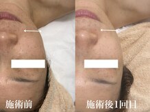 キーオブフェイス(Key of Face)/KF式小顔筋膜メソッド♪