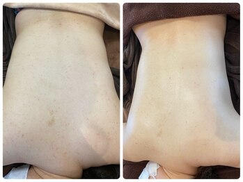 エヌエースキン 北谷店(NAskin)/ハーブピーリング｜背中ケア