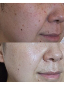 ザ シー タイムレスビューティ(THE SHE)/40代お客様症例写真