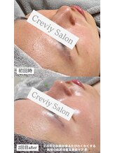 クレヴィー(Creviy)/韓国式3D毛穴洗浄＆REVlハーブ