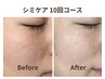 【春夏の紫外線対策に】シミケア10分 7000円→4200円