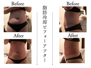 クローネ(Krone)/脂肪冷却ビフォーアフター