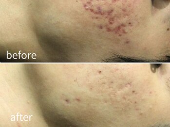 ソレイユ(Soleil)/ニキビ・肌荒れ