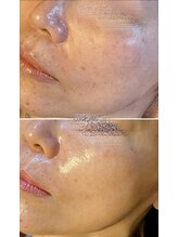 オリエンタルビューティー(ORIENTAL BEAUTY)/光フェイシャル×プラズマ