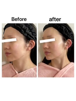 ブルームエイト(Bloom8)/高濃度プラセンタ原液