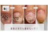 リプロ深爪矯正無料カウンセリング