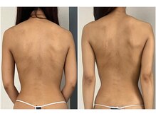 モア(moa)/ブライダルエステ