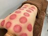 【疲れが取れない/自律神経の乱れが気になる方に】カッピング¥8,250→¥3,980
