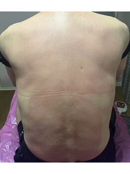 スパチャーレ(Spa ciare)/トーンヌール貼布後