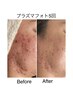 色白美肌・ニキビ改善◎あらゆるお悩みに！プラズマフォトショート(60分)