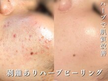 ダリア(Dahlia)/ハーブで自信の持てる素肌へ