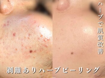 ダリア(Dahlia)/ハーブで自信の持てる素肌へ