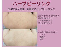 アンティクイーン(Antiqueen)の雰囲気（【剥けるハーブピーリング】肌荒れやニキビケアが得意♪結果重視）