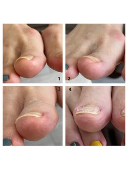 ミミ(mimi)/巻き爪ケア