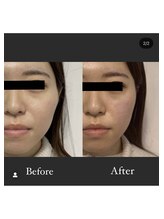 カドモリ 恵比寿代官山(KADOMORI)/小顔矯正 Before After【小顔】