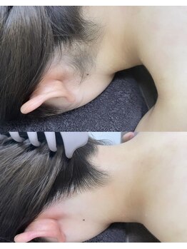 カルディエ(Cardie)/うなじ脱毛　ビフォーアフター