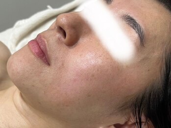 ビューティーサロン アンド ユー シブヤ(Beauty Salon&U Shibuya)/クリスティーナ施術１回後