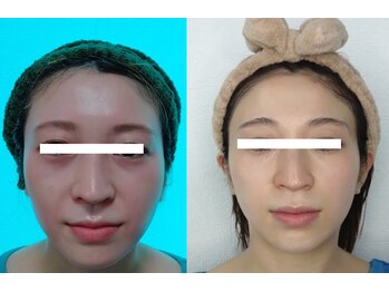 ソフィーム/小顔　美白　輪郭　整いました。