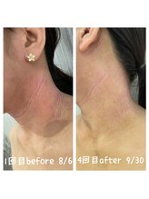 ハナヨサロン(hanayo salon)/敏感肌/肌質改善