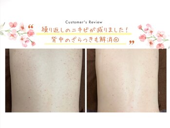 ブリス 渋谷駅前(BliSS)/ハーブピーリング|乾燥ニキビ