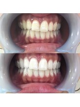 ラブホワイトニング 恵比寿店(LOVEホワイトニング)/【初回限定】2回照射¥980