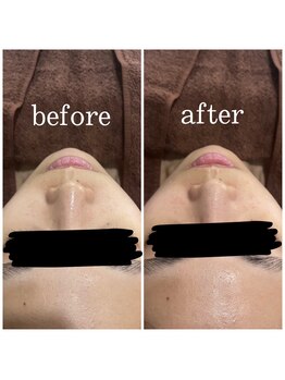 アイリーン(IRENE)/毛穴洗浄+炭酸パックの効果♪