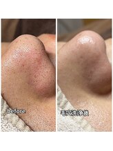 メンズガーデン(men's Garden)/毛穴洗浄で黒ずみ毛穴レス