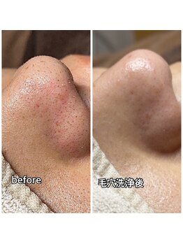 メンズガーデン(men's Garden)/毛穴洗浄で黒ずみ毛穴レス