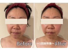 ディオネ/痩身ビフォーアフター