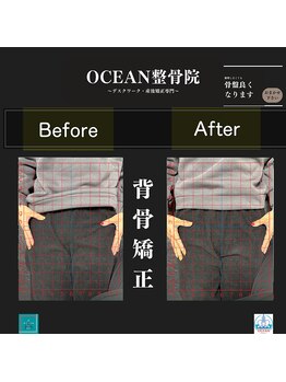 オーシャン整骨院(OCEAN整骨院)/背骨矯正の骨盤ビフォーアフター