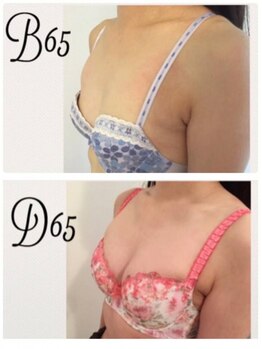 美人バスト 町田店/バストアップ◇症例◇