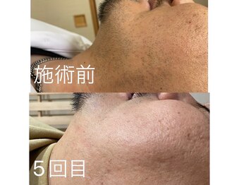 悠/メンズ☆ヒゲ脱毛