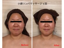 アイリス(AIRIS)/小顔にお悩みの方