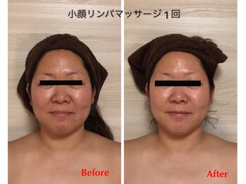 アイリス(AIRIS)/小顔にお悩みの方