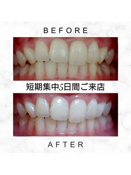 エミリアホワイトニング(EMIRIA WHITENING)/Before/After
