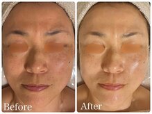 ロイヤル(ROYAL)/シミ/くすみ改善症例