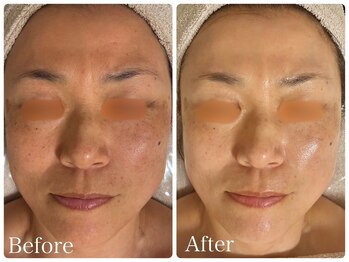 ロイヤル(ROYAL)/シミ/くすみ改善症例